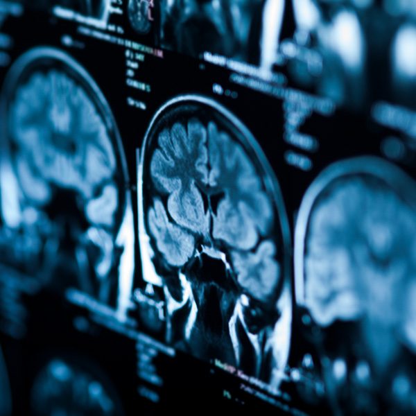 The X-ray of the human brain